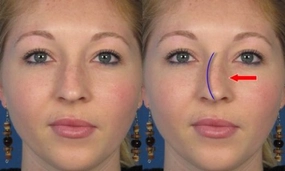 Burun Kemiği Eğriliğinin Tanısı ve Tedavisi